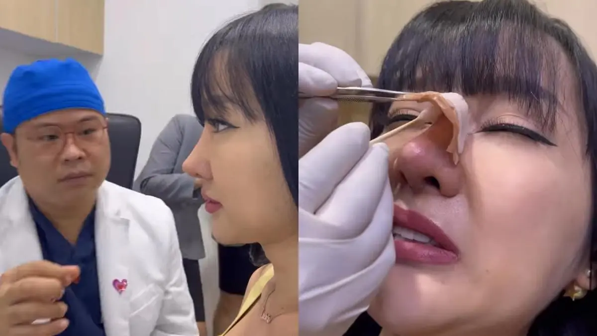 artis yang filler hidung