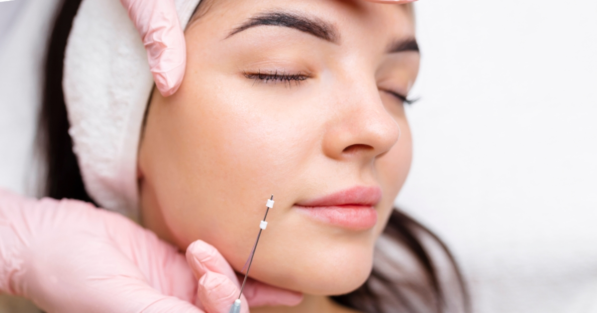 nose thread lift adalah