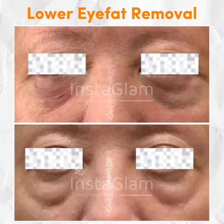 before after eye fat removal atau operasi lemak mata