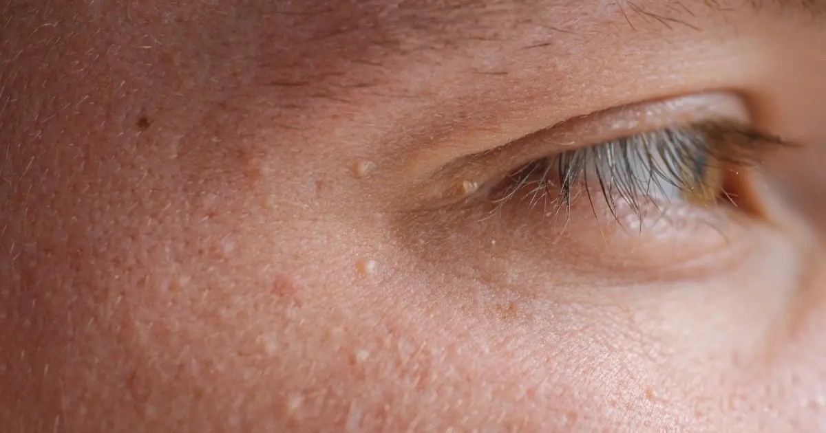 apakah milia bisa membesar