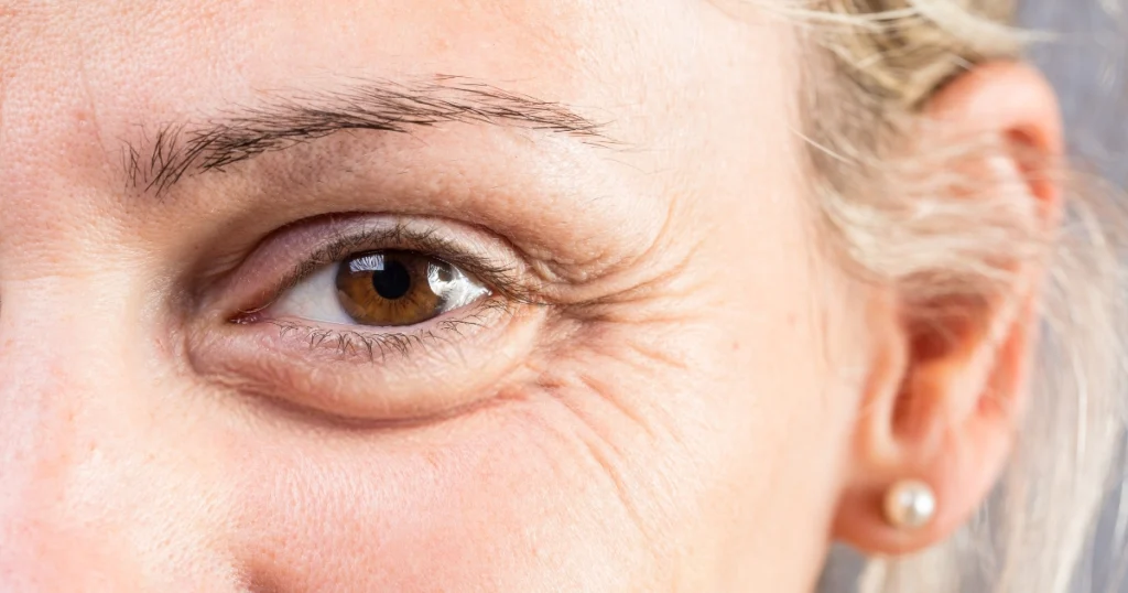 cara menghilangkan garis mata