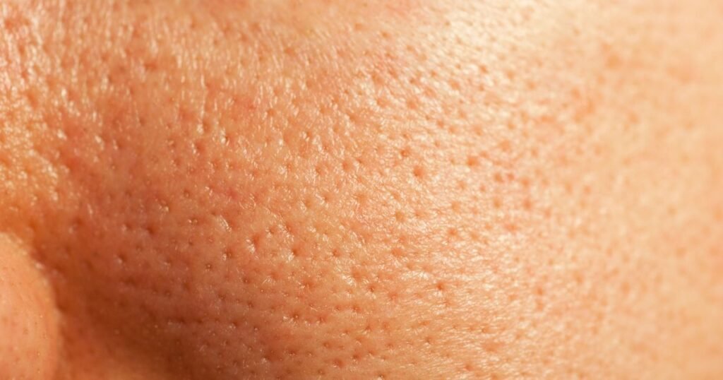 harga treatment mengecilkan pori pori