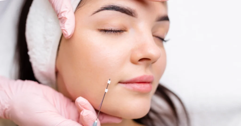 nose thread lift adalah