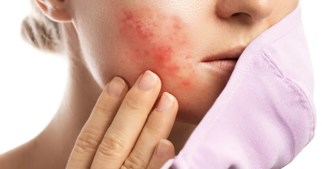 penyebab jerawat