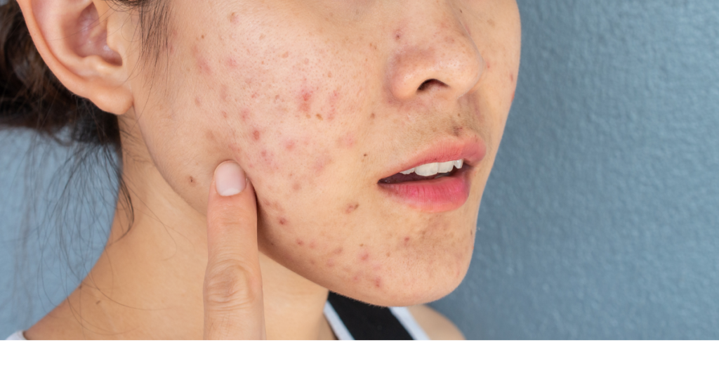 kapan bekas jerawat akan hilang