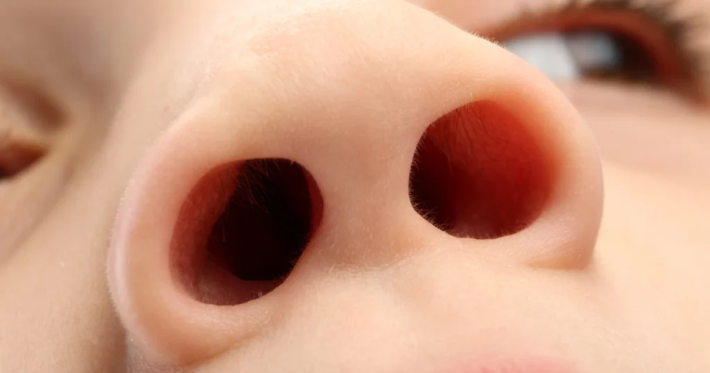 penyebab cuping hidung melebar