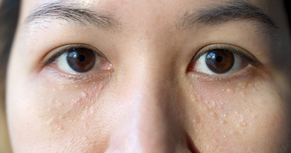 milia terjadi karena