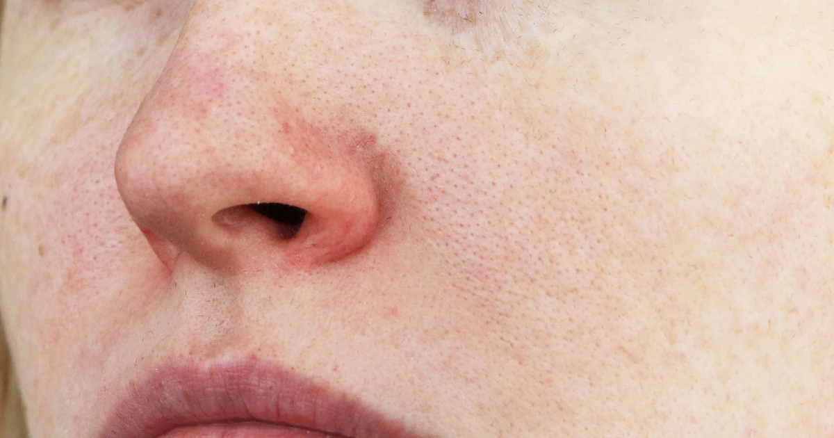 Air Dingin Bikin Pori-pori Mengecil