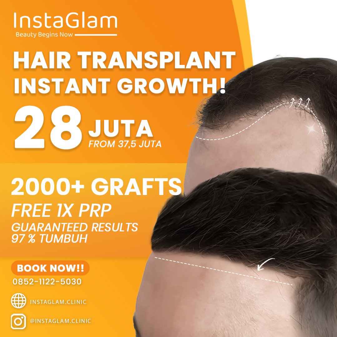 hair transplant