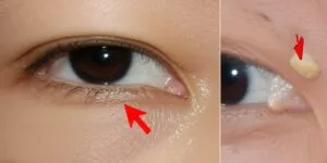 Xanthelasma Gejala Penyebab Pengobatan Dan Perawatan Terkini 