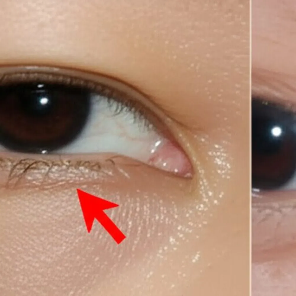 Xanthelasma-Gejala-Penyebab-Pengobatan-dan-Perawatan-Terkini-
