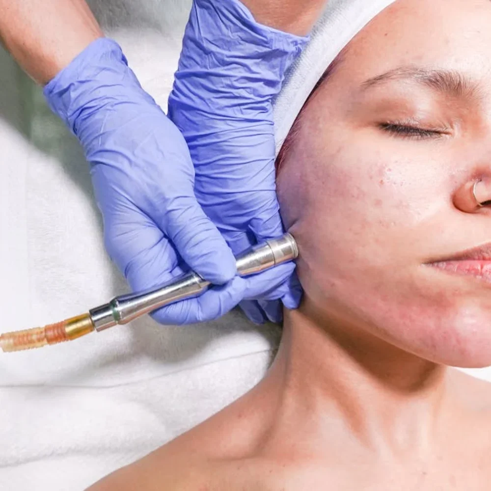 penyebab jerawat putih